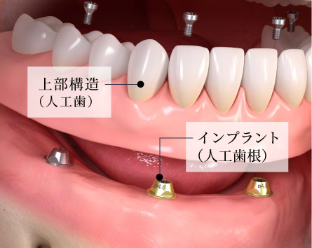 上部構造（人工歯）／インプラント（人工歯根）