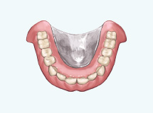 コバルトクロム床義歯