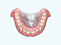 チタン床義歯