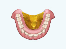 ゴールド床義歯