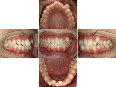 CASE 01 歯並びをきれいにしたい