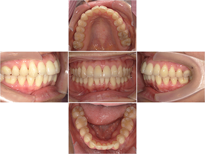 CASE 02 出っ歯を治したい