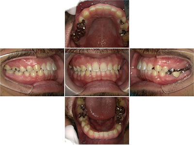 CASE 04 すきっ歯を治したい