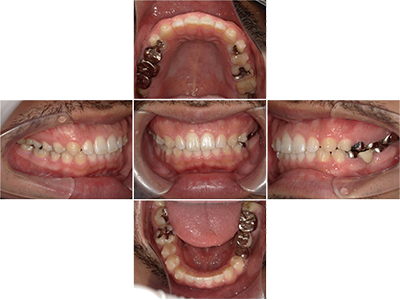 CASE 04 すきっ歯を治したい