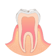 歯の表面にむし歯ができます