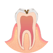 むし歯が神経に近くなり、冷たいものがしみます