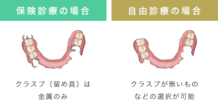 保険診療の場合クラスプ（留め具）は金属のみ 自由診療の場合クラスプが無いものなどの選択が可能