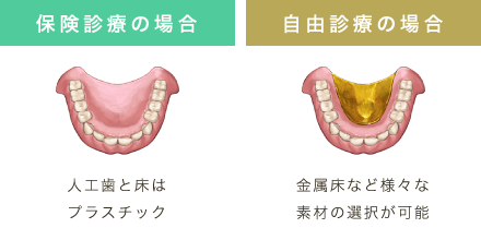 保険診療の場合人工歯と床はプラスチック 自由診療の場合金属床など様々な素材の選択が可能