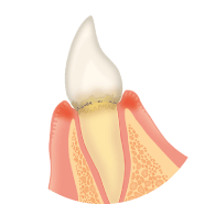 歯と歯茎の間に歯垢がたまります